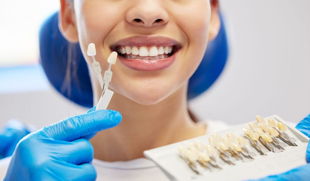 dental veneers for stained teeth