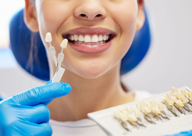 dental veneers for stained teeth