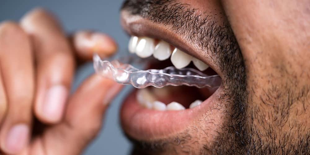 Invisalign in York