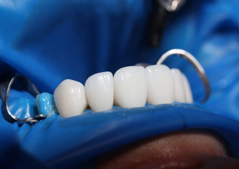 dental implants York