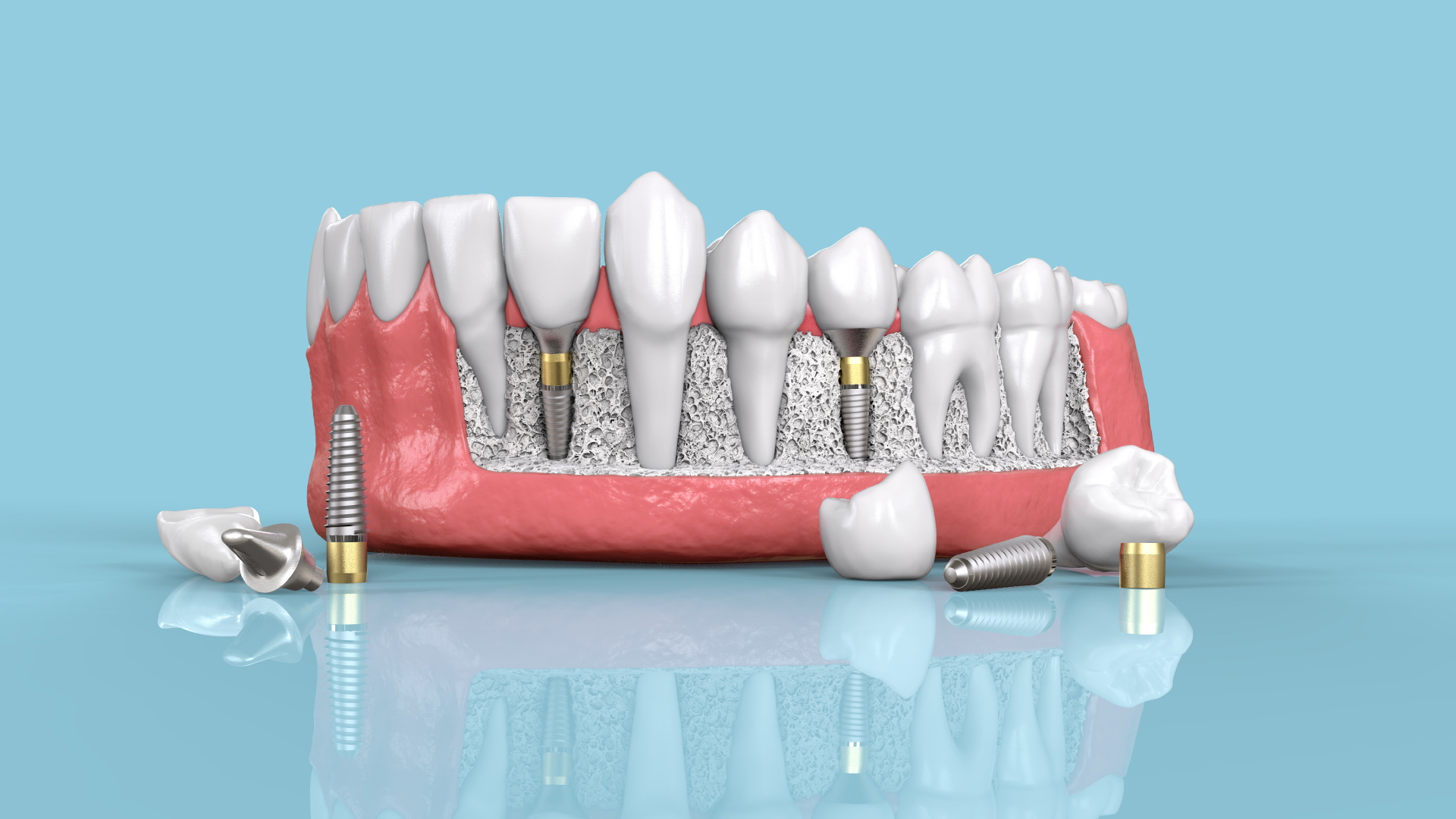 dental implants York