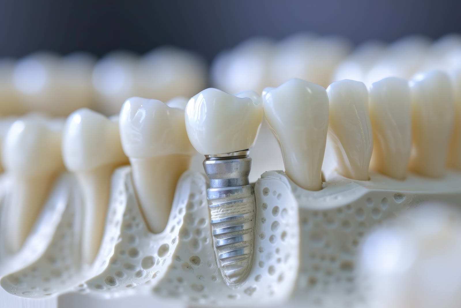 how long do dental implants last
