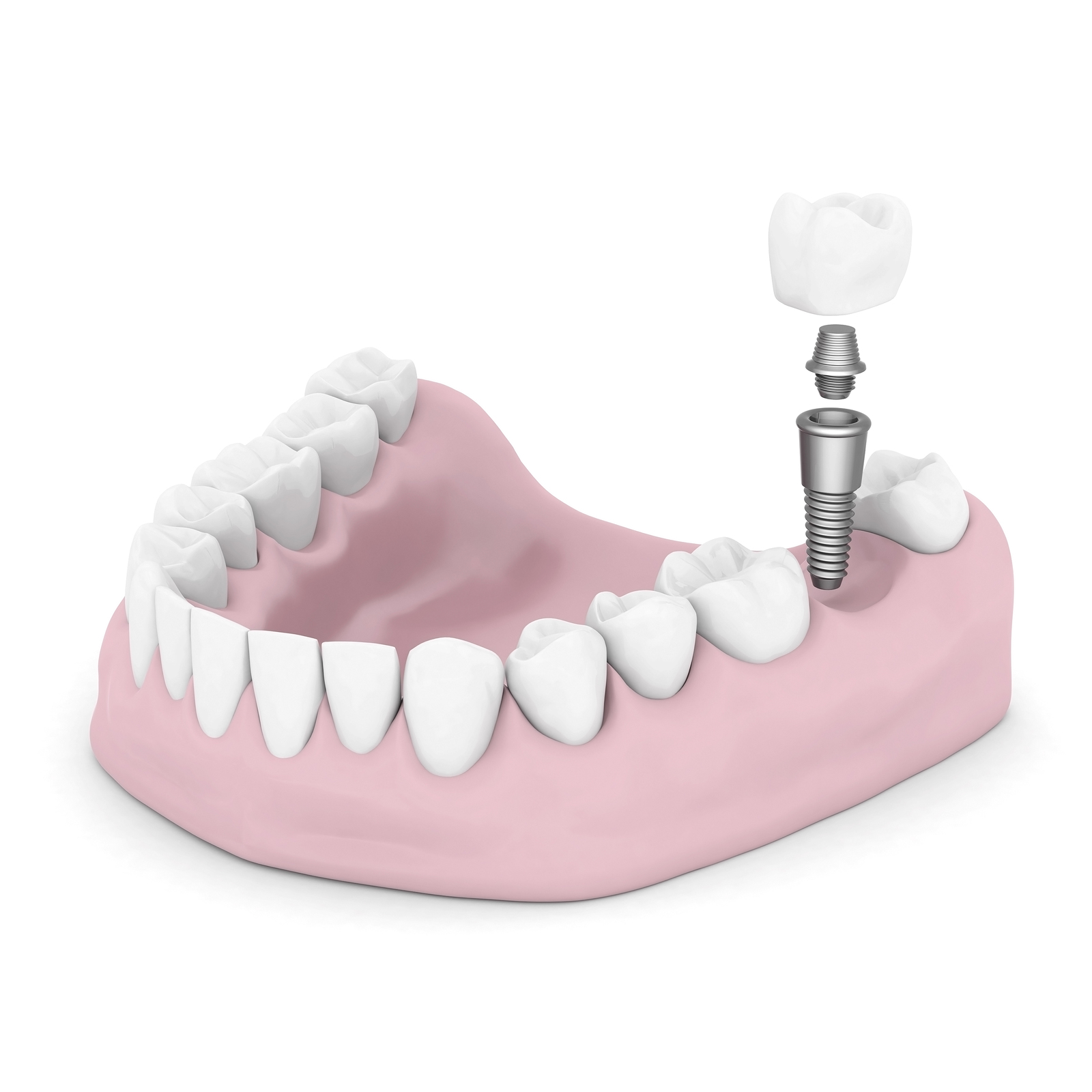 dental implants in York